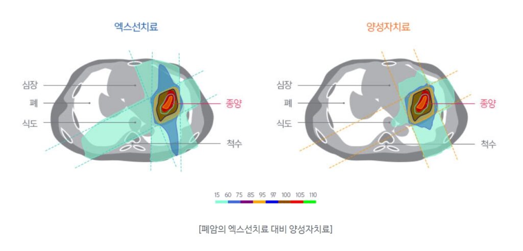 폐암과 양성자치료